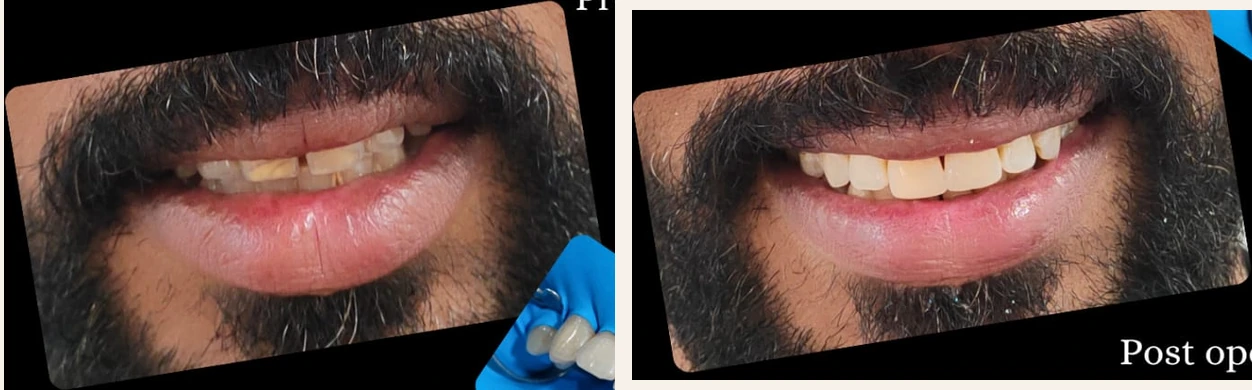 Cosmetic smile restoration case, before and after photographs