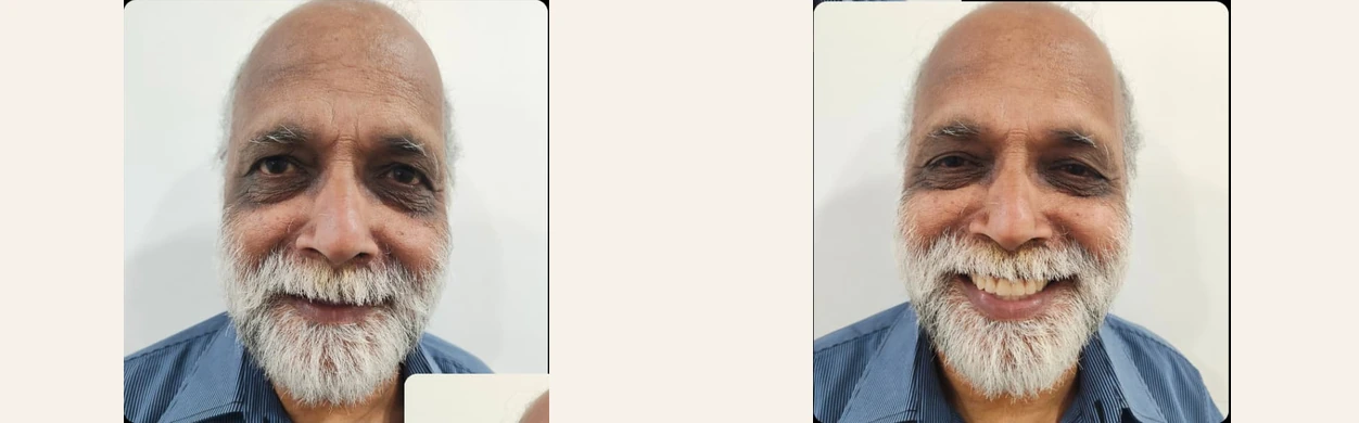 Prosthodontic case showing the patient's smile before and after rehabilitation